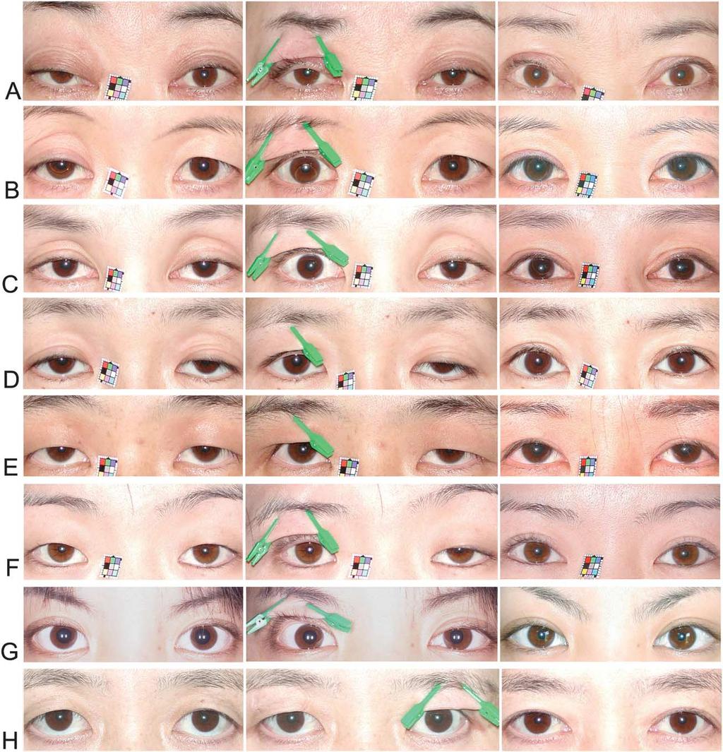 Dynamic lower scleral show 673 Figure 4 Changes of lower scleral show in eight patients. In the left column are pre-operative photos.