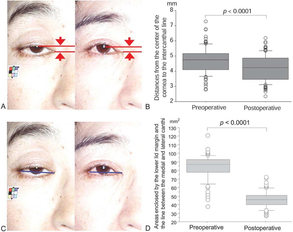 674 K. Matsuo et al. Figure 5 Statistical analysis of the global position in the orbit and the degree of retraction of the lower eyelid.