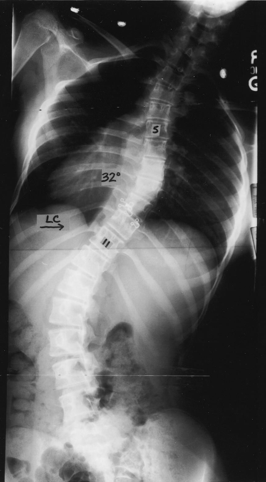 G.L.) retrospectively reviewed radiographs of 315 consecutive patients with operatively treated scoliosis to assess the prevalence of curve types in a typical surgical practice.