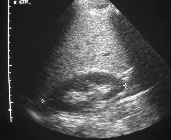 Some renal disease are macroscopic Ultrasound Size Small bad Normal, 10-11 cm good