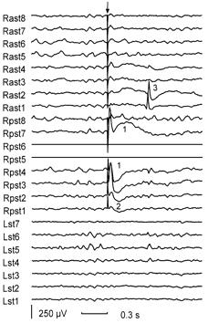 Single Pulse Electrical Stimulation (SPES) 1 & 2 : Early Responses < 100 ms 3 : Delayed