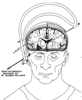 neurosurgery Anterior choroidal