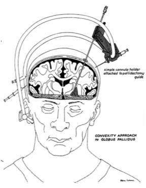 Parkinsonism: Its Medical and
