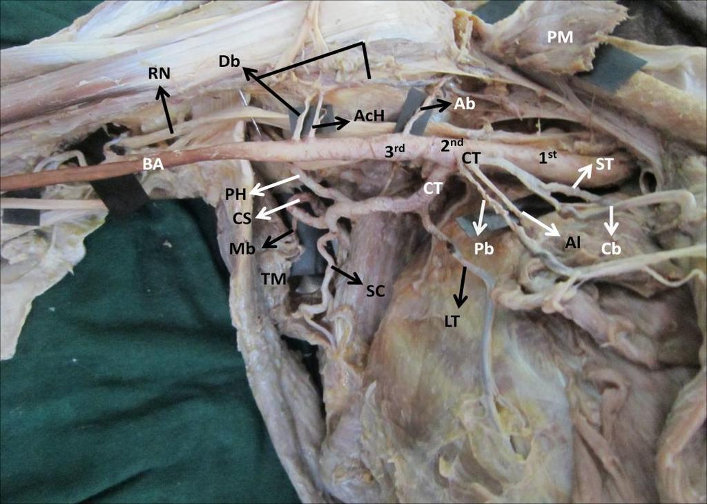 anteriorly: First part gives superior thoracic artery, second part gives thoracoacromial artery, lateral thoracic artery and third part gives subscapular artery, anterior and posterior circumflex