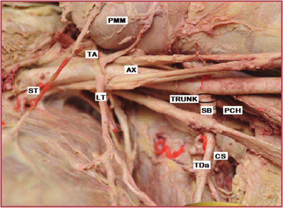 posterior circumflex humeral artery. bsent S. The S was absent in 11 cases (11%), of which 4 were females (2 on the left and 2 on the right) and 7 were males (4 on the left and 3 on the right).