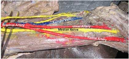 Fig 2: Right upper limb showing high division of brachial artery into radial and ulnar artery in the arm.