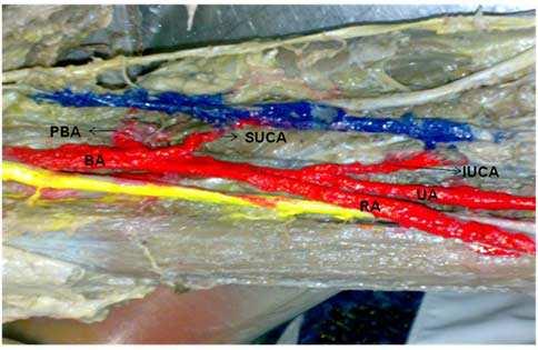 superior ulnar collateral artery (SUCA) arising from brachial artery before division.