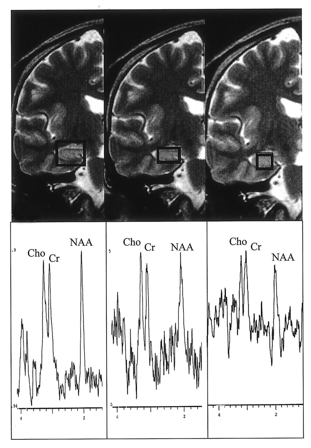 Single Voxel Proton MR Spectroscopy in Evaluation of Hippocampal Sclerosis Cho or NAA/Cr ratio below the threshold values was interpreted as abnormal.