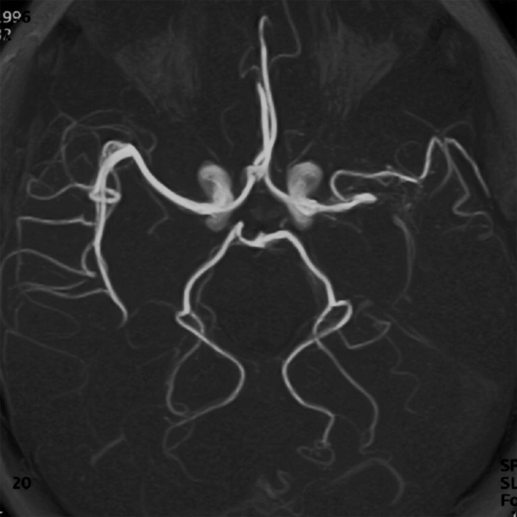 Fig. 6: MCA stenosis in a 22 year-old woman.