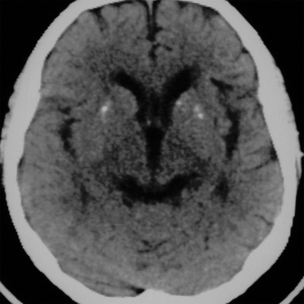 Fig. 10: Calcification in the basal ganglia in a