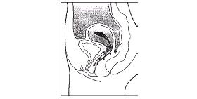 ESTRING may slide down into the lower part of the vagina as a result of the abdominal pressure or straining that sometimes accompanies constipation.