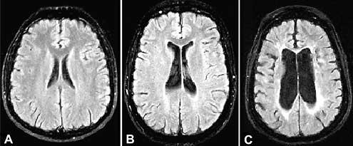 Subclinical Infarction, and Brain