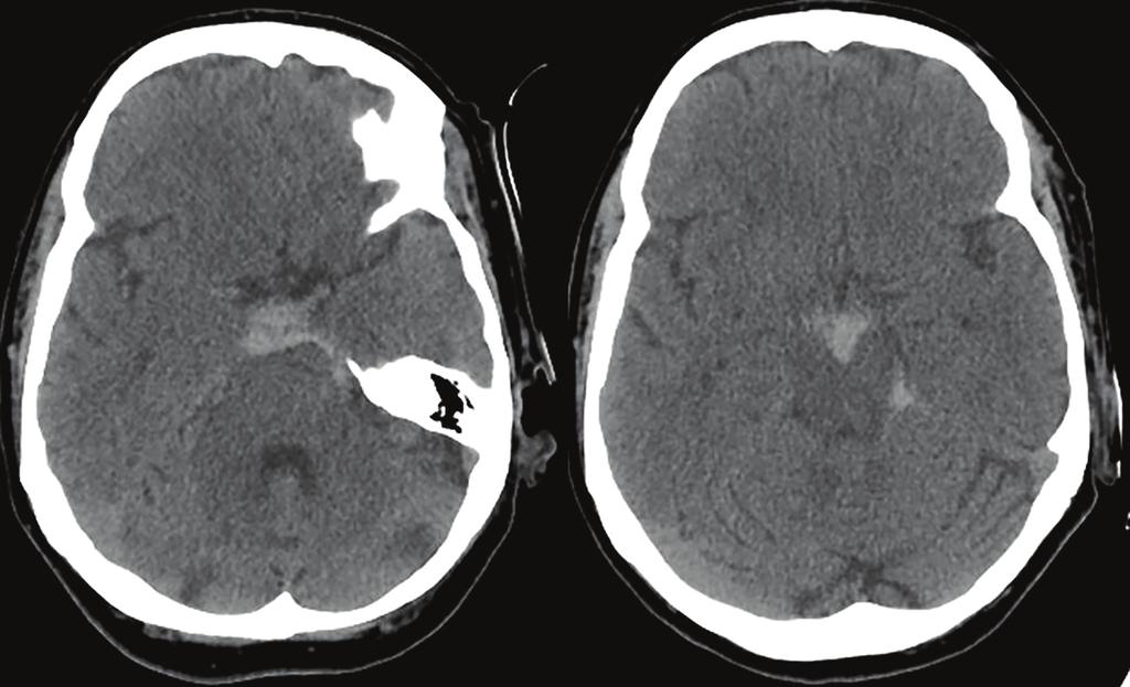 2 Case Reports in Neurological Medicine Figure 1: CT of the head demonstrated subarachnoid hemorrhage in the perimesencephalic, prepontine, interpeduncular cisterns.