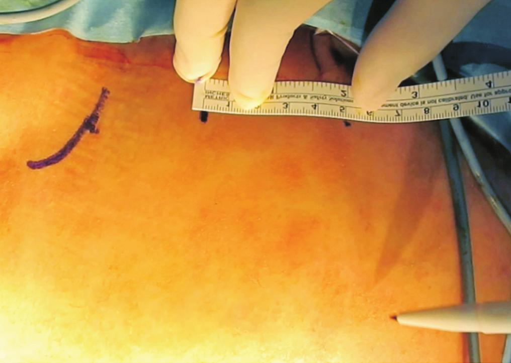 (D) Operation is performed at the patients left side regardless of hernia location.