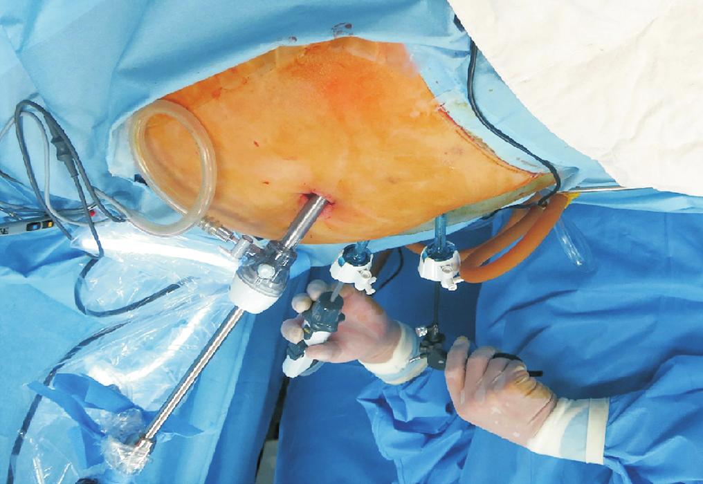 hernia, and discuss the initial results.