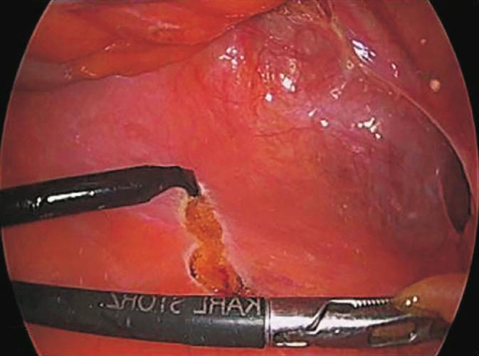 (B) Preperitoneal space was dissected with sharp and blunt dissection using electrocautery device with angled tip.