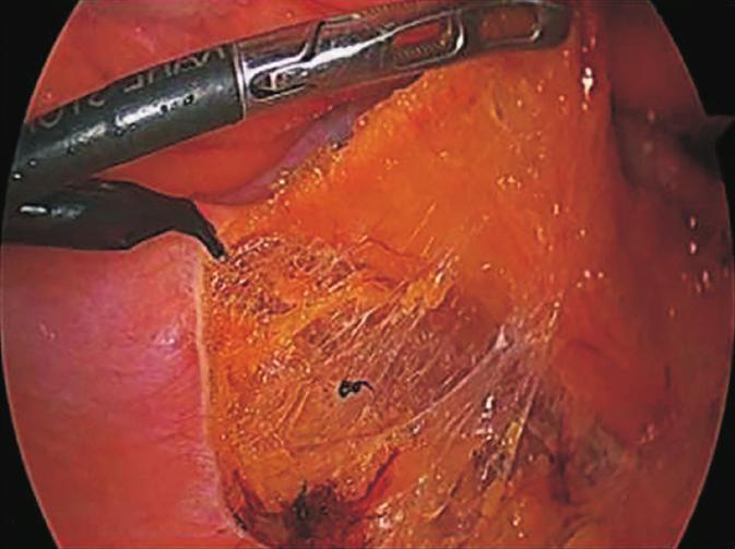 (D, E) Hernia sac was dissected, and vas deference and spermatic vessels were dissected from hernia sac.