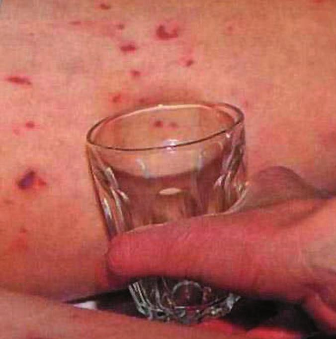 Do the glass test Someone with septicaemia may develop a few spots or a widespread rash with fever. Later on the rash can develop into purple blotches that do not fade under pressure.