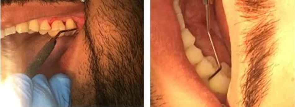 Citation: Mirdan B, Rashid A. Regenerative treatment of periodontitis using diode laser: Case study. J Oral Med Toxicol 2018;1(2):1-5. on molar region area for the maxilla and mandible.