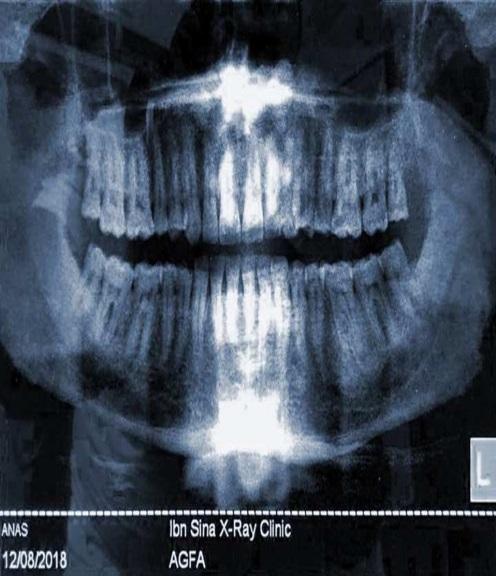 Periapical x-ray for case 1 to the selected region during the treatment period accordingly. Figure 3.