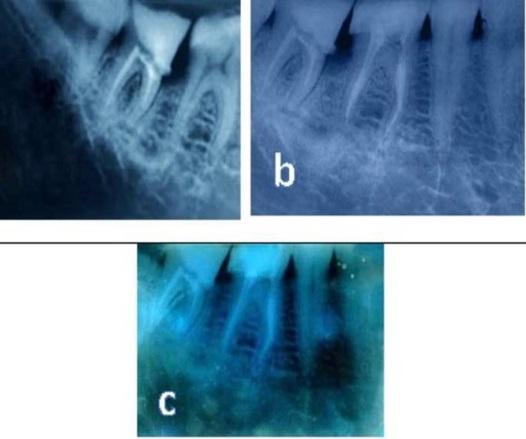 Citation: Mirdan B, Rashid A. Regenerative treatment of periodontitis using diode laser: Case study. J Oral Med Toxicol 2018;1(2):1-5.