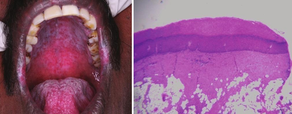 Figure 1: () Orl sumucous firosis with leukoplki, () hyperkertosis with mild dysplsi Methods Smple collection Unstimulted whole sliv from the prticipnts ws collected etween 6 nd 11 m fter providing