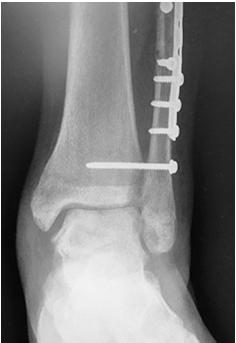 Failed Fixation/Instability Mark M. Casillas, M.D. Orthopaedic Surgery, Foot & Ankle Jeremy L. Dickerson, M.D. Family Practice, Sports Medicine Stacé S.