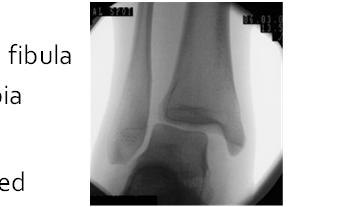 AITFL (2) PITFL (1) IOL Syndesmosis Ligaments The syndesmosis Syndesmosis Injury Stabilizes distal tibia and