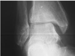 increases joint surface pressure by 42% Alexander I J, The Foot: Examination and Diagnosis Syndesmosis Injury A