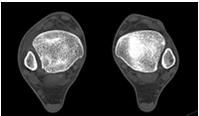 CT Syndesmosis Imaging Axial Comparision