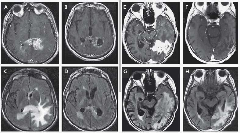 Adult Brain Tumor: Targeted Therapeutics Responders Erlotonib/rapamycin