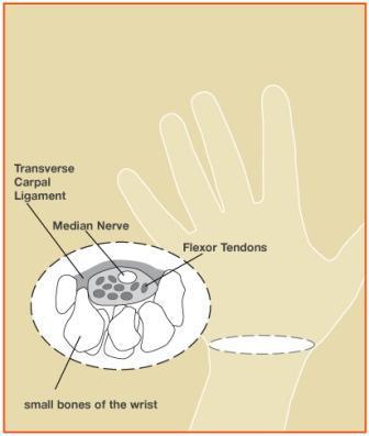 CTS is HAND numbness AND pain, from a PINCHED MEDIAN NERVE in the wrist within the ONE inch section of the