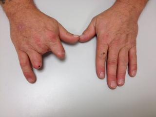 Real hand impairment and disability -48 yo wood worker -dominant hand table saw accident mangled index, middle,
