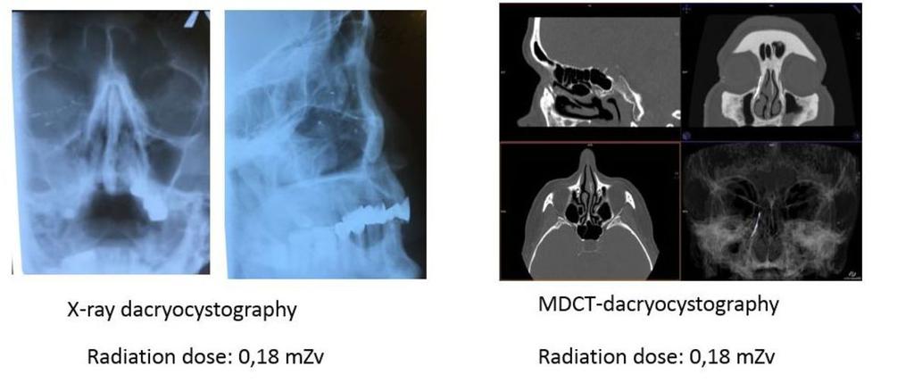Conclusion Both CT-DCG and DCG may be used in the preoperative assessment of patients suspected for having lacrimal drainage system obstruction, and they allow to diagnose the level of obstruction