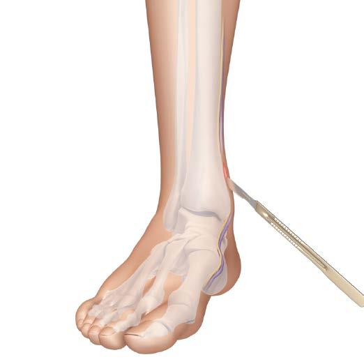 APPROACH Approach Make a medial incision through the skin and subcutis slightly above the level of ankle joint and over the medial malleolus and distal tibia.