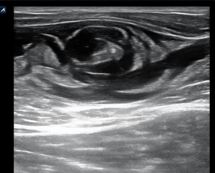 DU Guided tumescence of Truncal Veins Patient in Trendelenburg position Begins at the site of the access