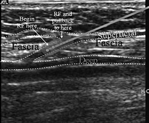 of the junction of the perforator vein, before it branches or bifurcates with the leg