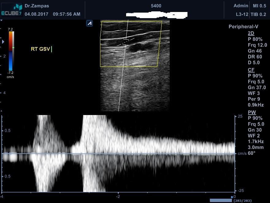 DVU diagnostic technique Superficial, deep and perforator veins in both a supine and upright or standing position Color doppler, pulsed wave doppler with a