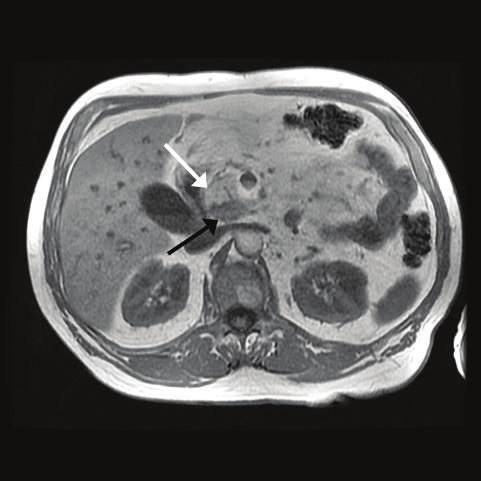 A computed tomography (CT) of the abdomen demonstrated diffuse intrahepatic biliary ductal dilatation.