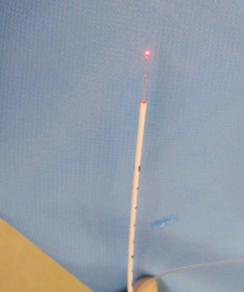 Endovenous thermal ablation