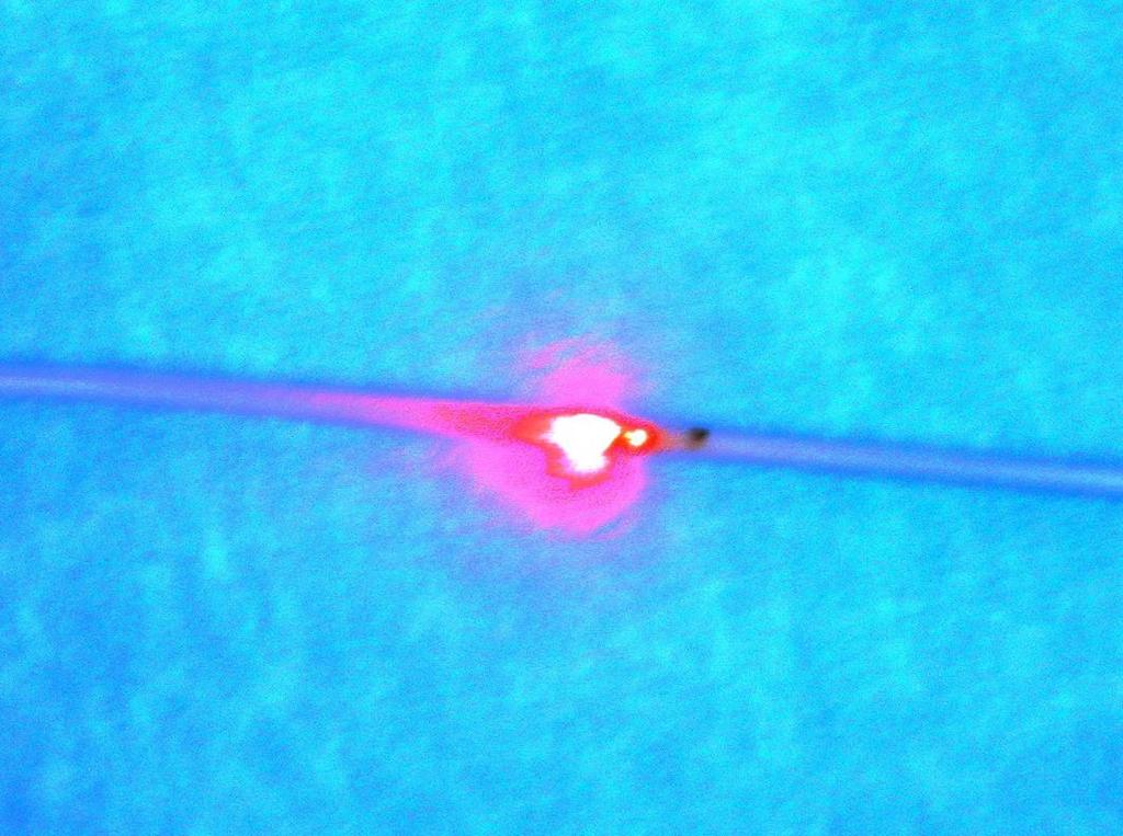 Catheter based treatments Endovenous thermal ablation EVLA RFA Steam MOCA