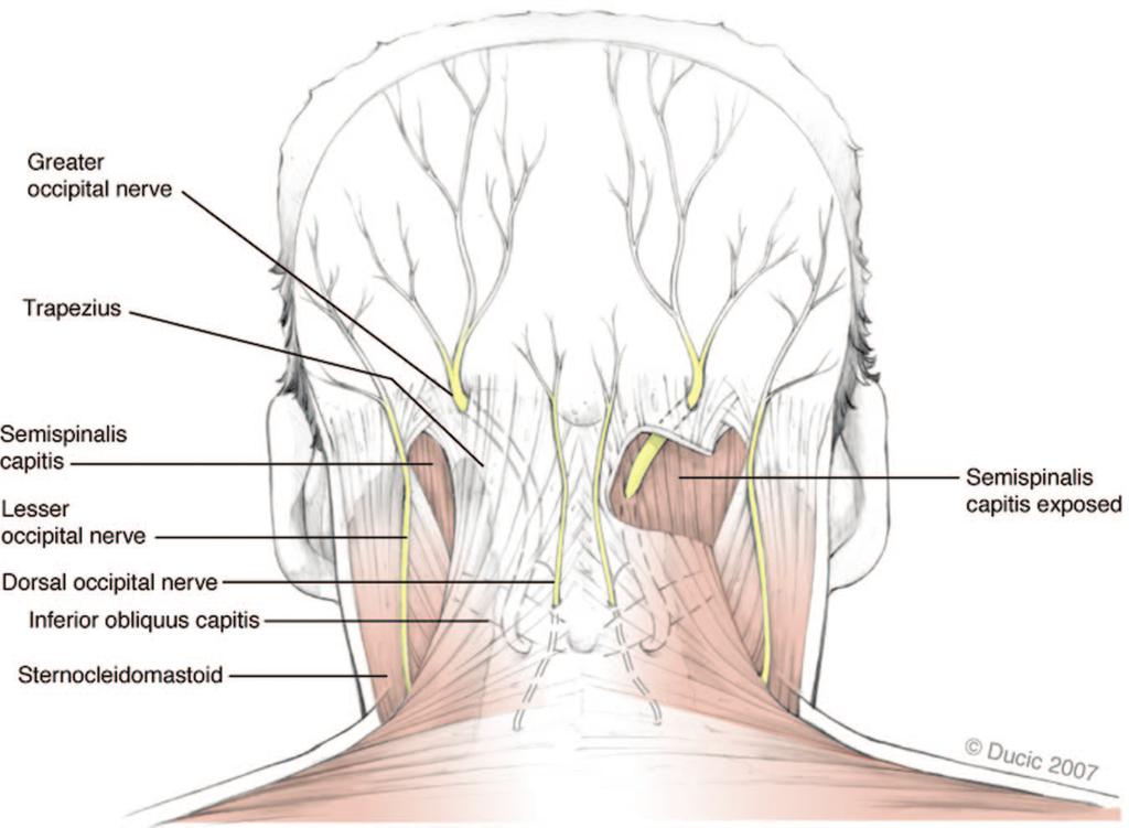 Plastic and Reconstructive Surgery March 2009 Fig. 4. Schematic illustration of the courses of the greater and lesser occipital nerves as suggested by the most common patterns in our study.