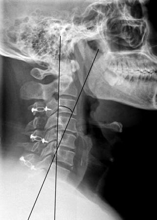 However, a lack of studies exist comparing titanium miniplate fixation with classical suture fixation. A B We performed a retrospective study of 54 patients with cervical myelopathy.
