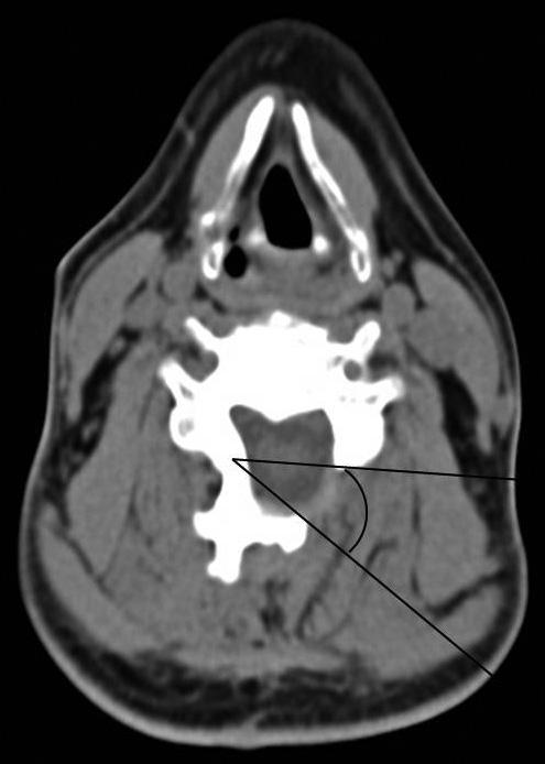 Preoperative sagittal magnetic resonance image showing multiple-level stenosis with the most severe disease at C3-C6 (C).