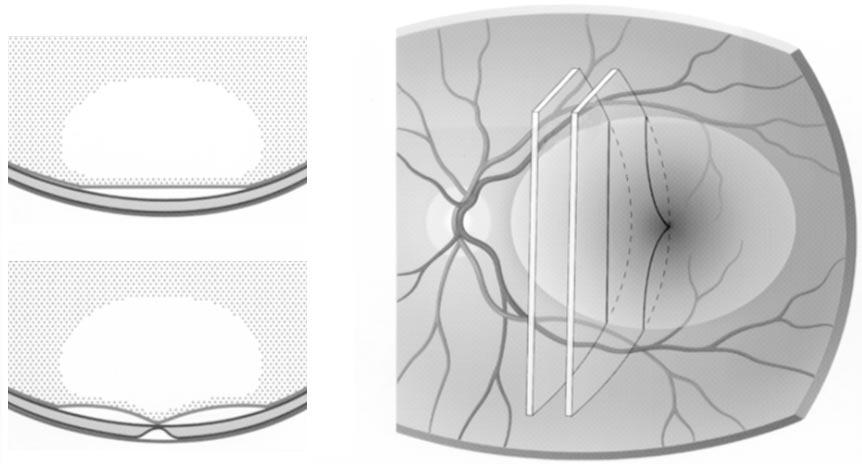 A A A Figure 2. Three-dimensional illustration of perifoveal cortical vitreous detachment with persistent foveolar adherence.