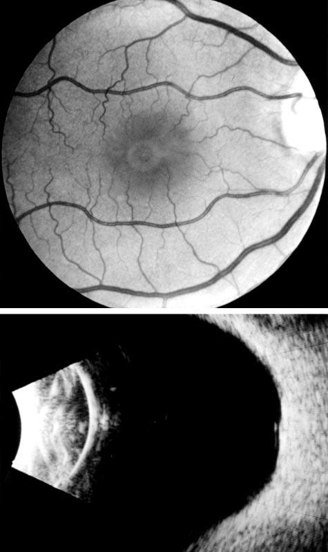 the foveola (). The clear area within the vitreous (dot matrix) in A and is the premacular liquefied vitreous pocket. A Figure 4.