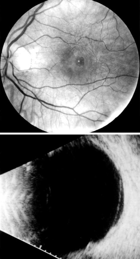 , Longitudinal -scan ultrasound shows shallow vitreous detachment extending temporally to approximately the equator, with vitreous adherence at the macular hole (arrow). Figure 3.