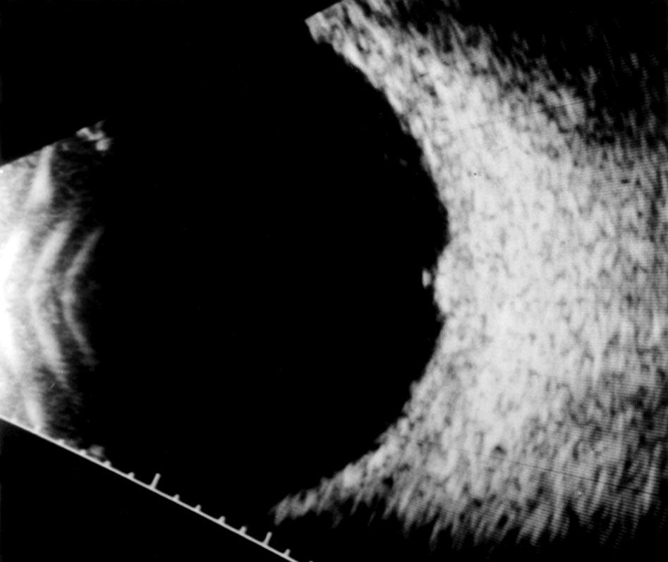Axial views were not obtained in this patient. Figure 5. Ultrasound images of operculated stage 2 macular hole.