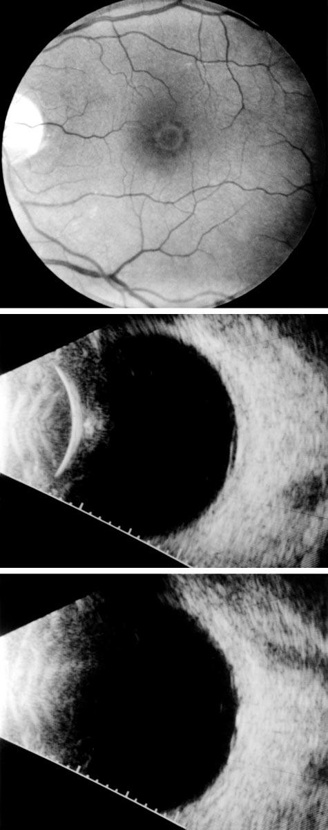 A Figure 8. Horizontal axial ultrasound through a stage 2 macular hole shows perifoveal vitreous detachment (arrowheads) with vitreous adherence at foveola (arrow). C Figure 7.