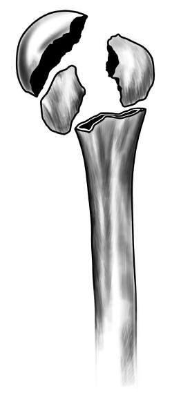Solar Humeral Fracture